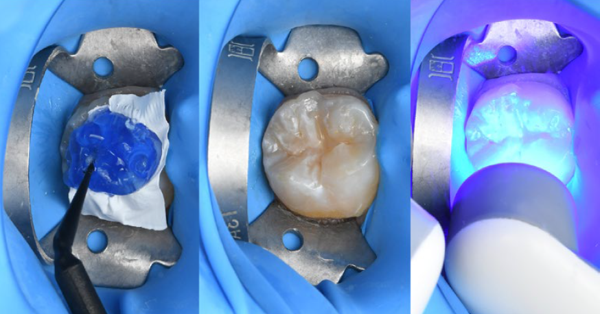 Fig. 10: Restoration procedure: Duplication the original occlusal surface with the stamp